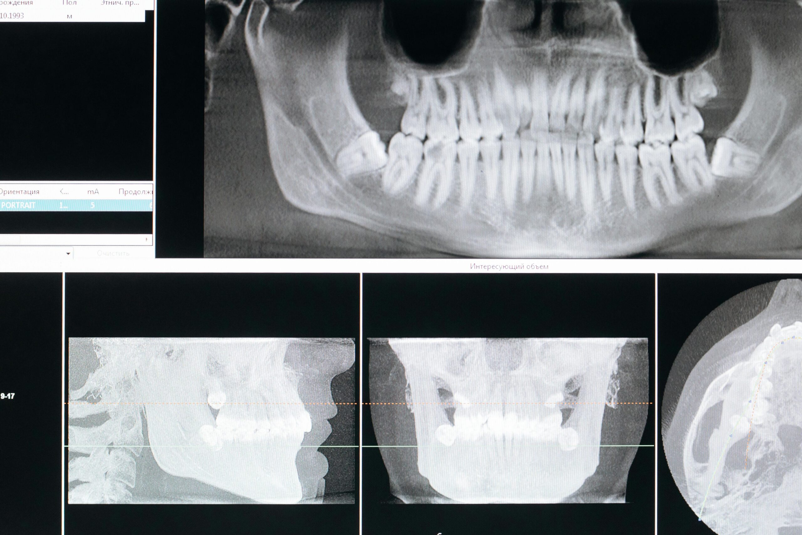 Detail image of a panoramic dental X-ray, showing teeth and jaw structure.