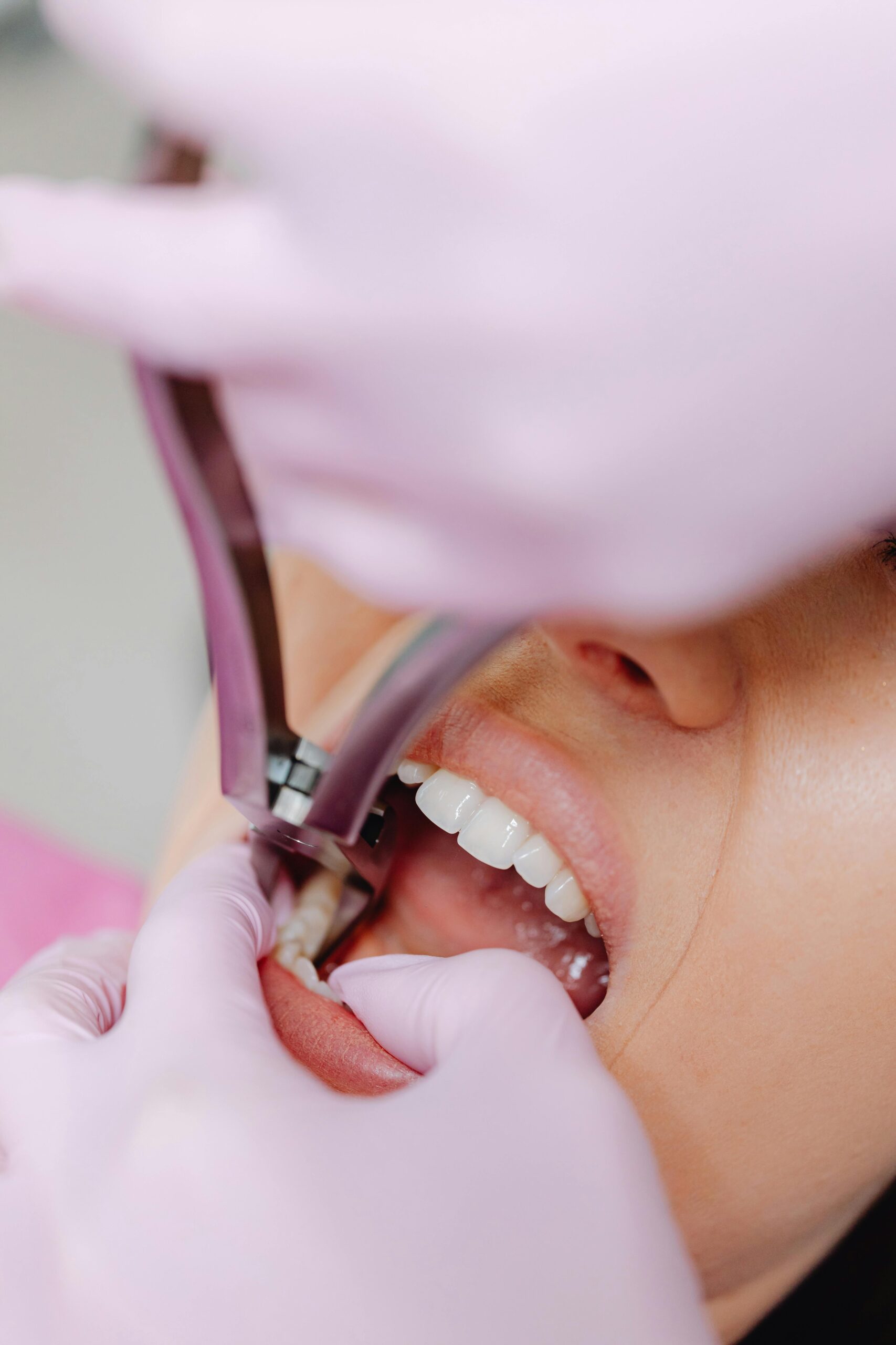 A dentist performs a tooth extraction on a patient using extraction forceps.